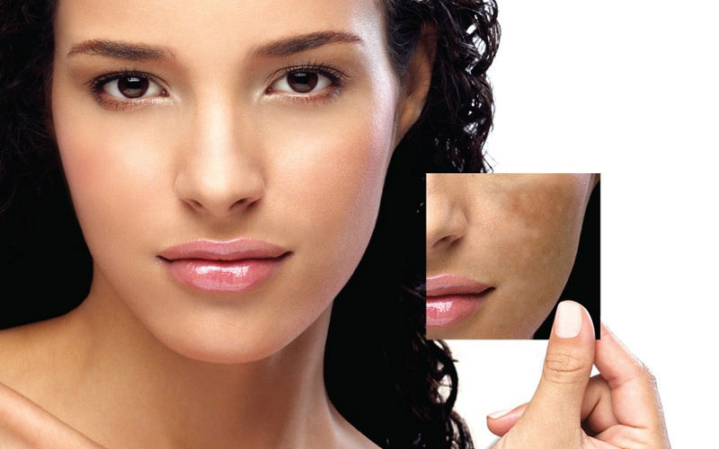 Understanding the Different Types of Laser Treatments for Pigmentation
