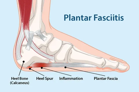 Why Ignoring Plantar Fasciitis Pain Can Lead to Long-term Tendon Damage and Inflammation